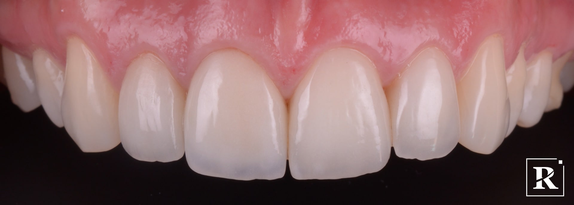 Amalia estetica dentara fatete dentare coroana dentara