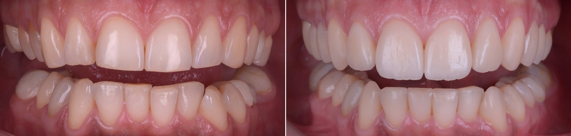 Felicia reabilitare complexa fatete coroane implanturi gutiera ATM rugina clinica dentara timisoara before after