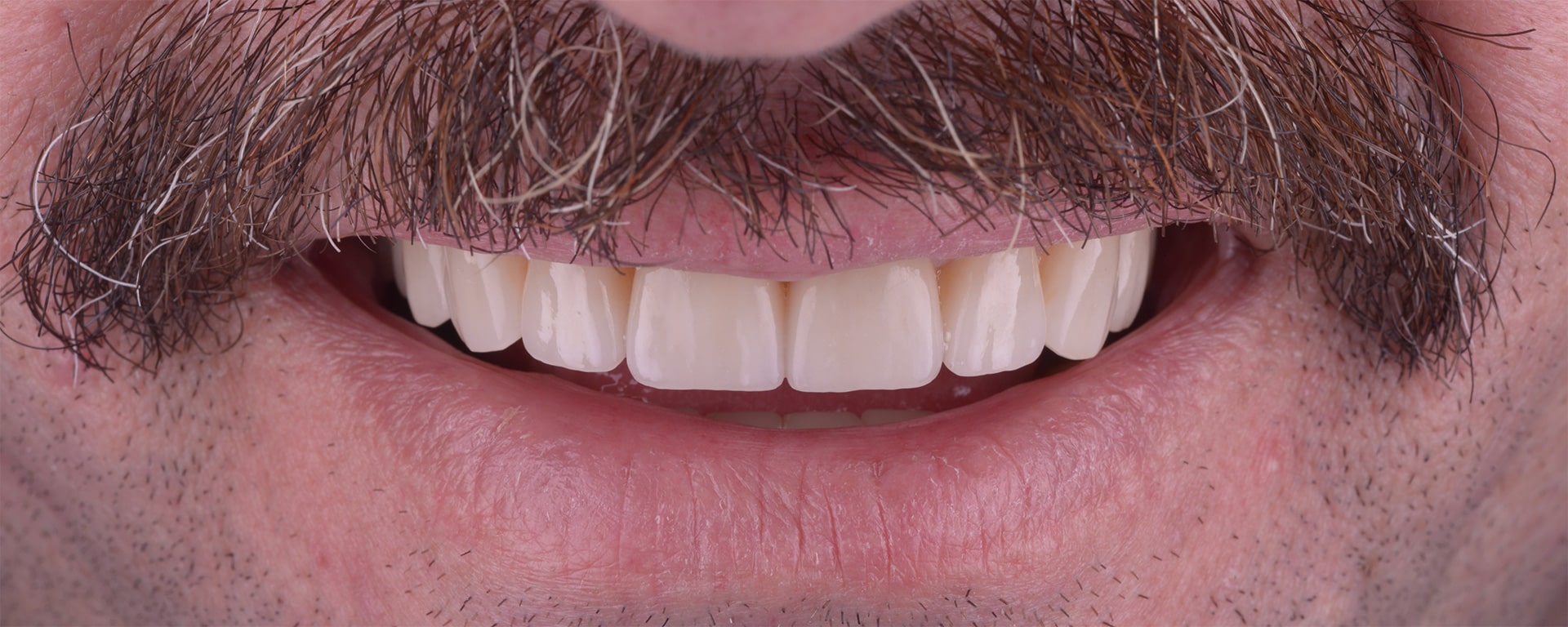 Nicolae reabilitare complexa protetica coroane dentare fatete implanturi dentare clinica dentara stomatologie timis