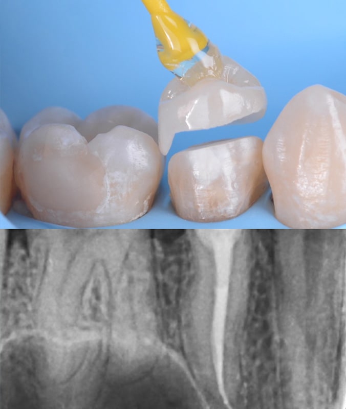 Tratamente Endodontice clinica dentara stomatologie timisoara clinica rugina