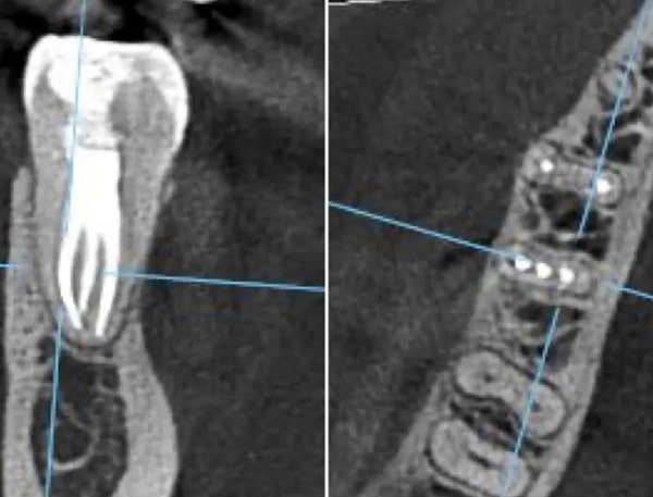 Tratamente Endodontice clinica dentara timisoara clinica rugina