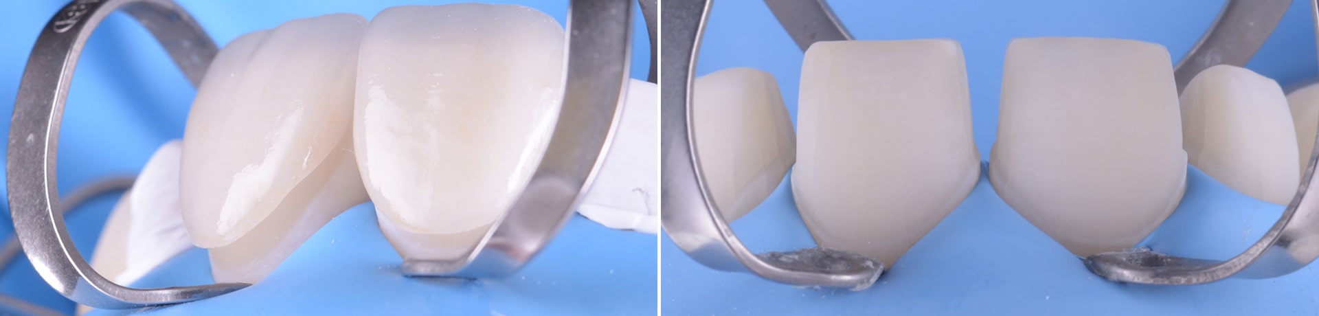 Tratamente protetice restaurari protetice clinica dentara timisoara clinica rugina clinica stomatologie timis