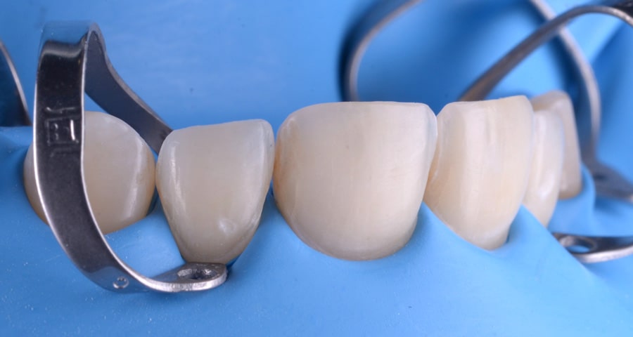 Tratamente protetice restaurari protetice clinica dentara timisoara clinica rugina clinica stomatologie