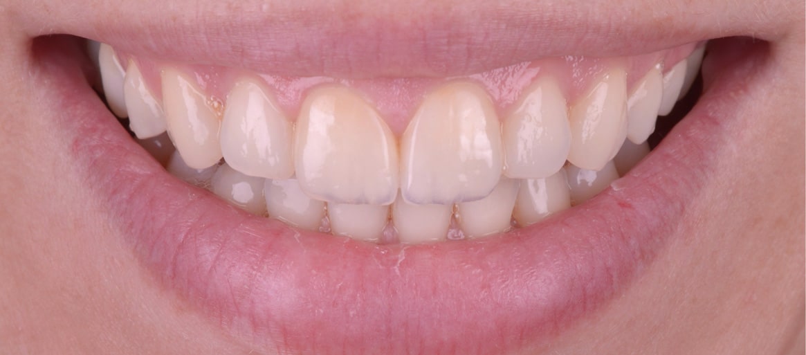 Tratamente protetice restaurari protetice clinica dentara timisoara clinica rugina