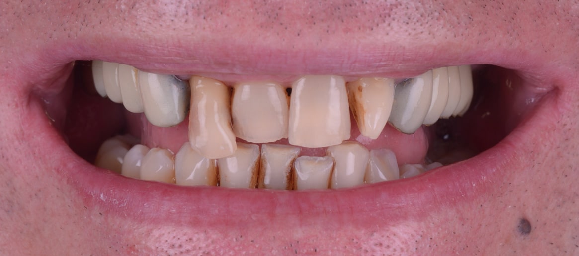 Vali reabilitare complexa punti si coroane dentare reconstructii din compozit alungiri coronare clinica dentara timisoara clinica rugina