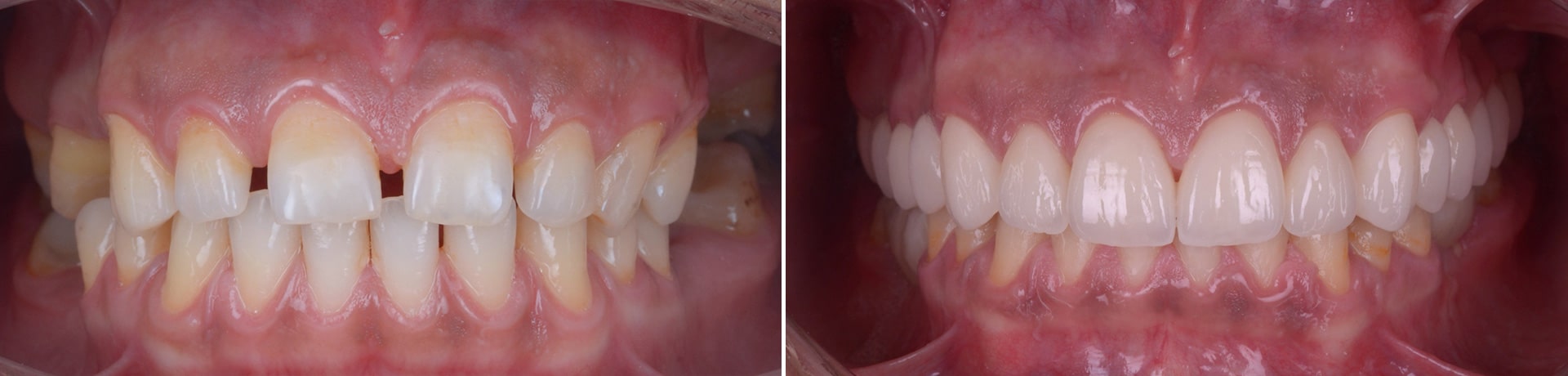 before after zambet functional cabinet stomatologie clinica dentara timisoara clinica rugina