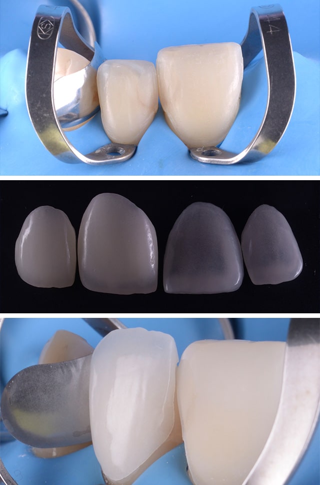 coroane dentare fatete dentare clinica rugina clinica dentara timisoara stomatologie