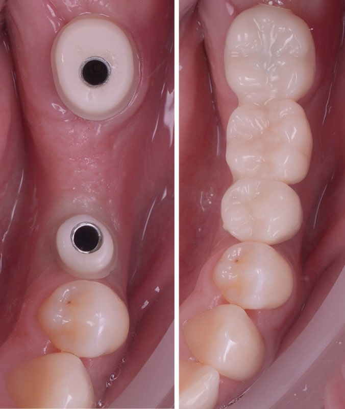 implanturi-dentare-restaurari clinica dentara timisoara rugina