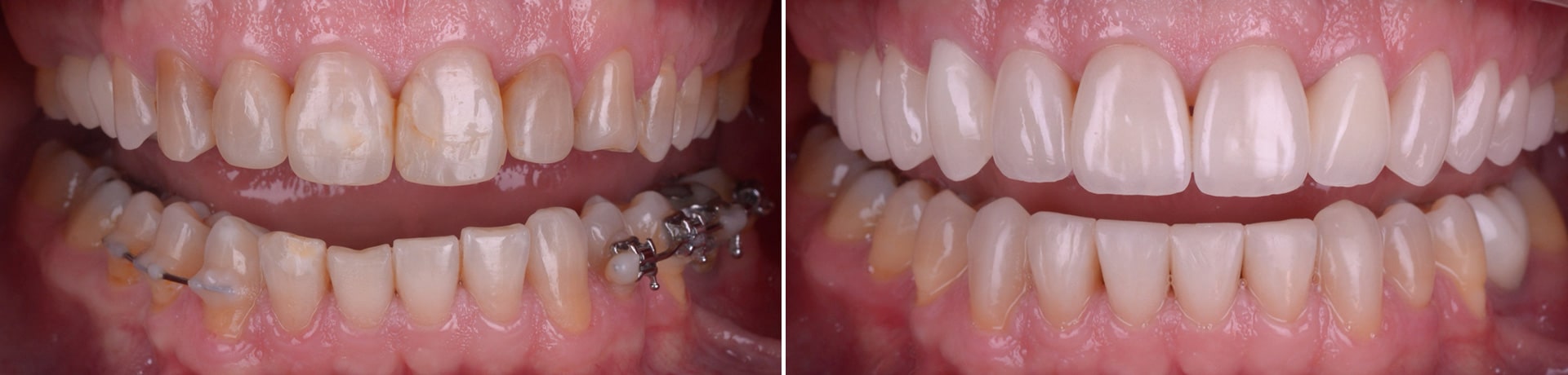 reabilitare complexa ortodontie fatete dentare coroane dentare punti dentare implanturi dentare reconstructii compozit gutiera atm clinica dentara timisoara stomatologie rugina