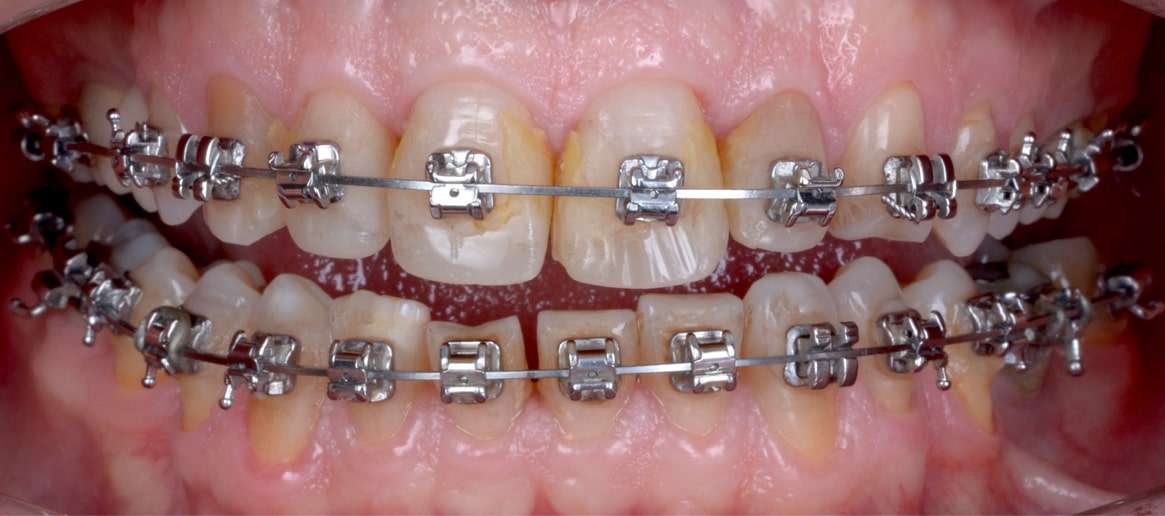 reabilitare complexa ortodontie fatete dentare coroane dentare punti dentare implanturi dentare reconstructii compozit gutiera atm clinica dentara timisoara