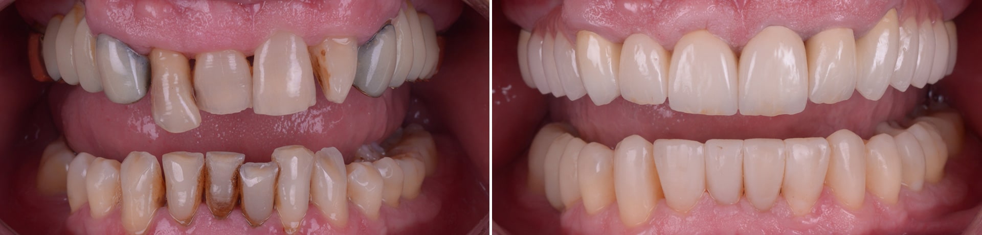 reabilitare complexa punti si coroane dentare reconstructii din compozit alungiri coronare clinica dentara timisoara clinica rugina stomatologie