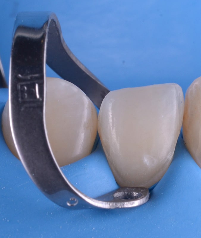 restaurari protetice scanare digitala fatete dentare incrustatii ceramice coroane dentare punti dentare clinica dentara timisoara rugina