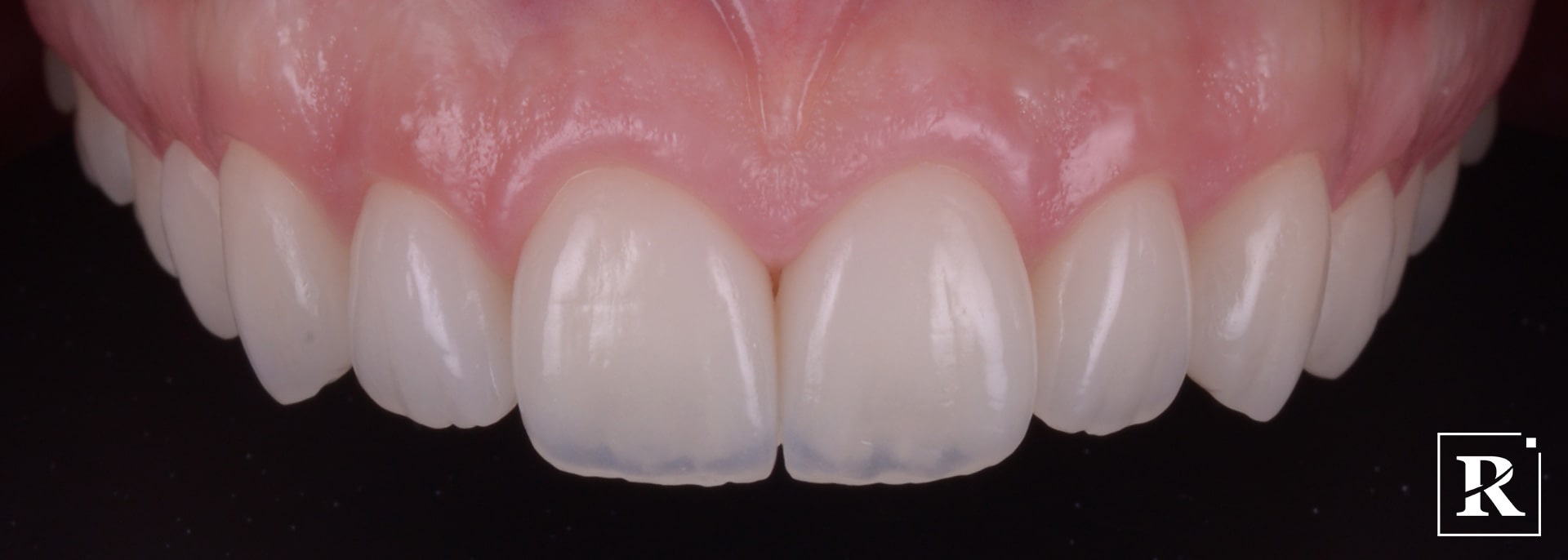 zambet estetic stomatologie clinica dentara timisoara clinica rugina