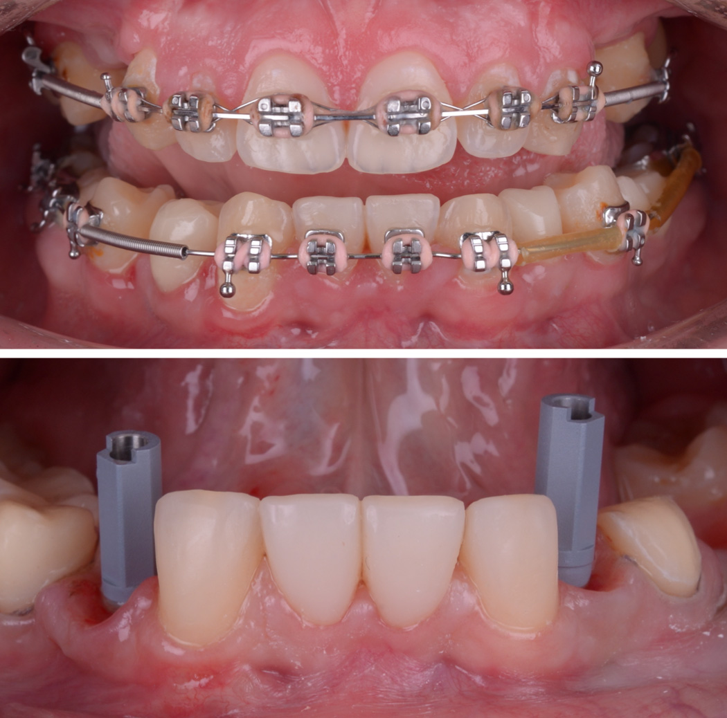 Daniela coroane dentare fatete si coroane din zirconiu pe implant dentar