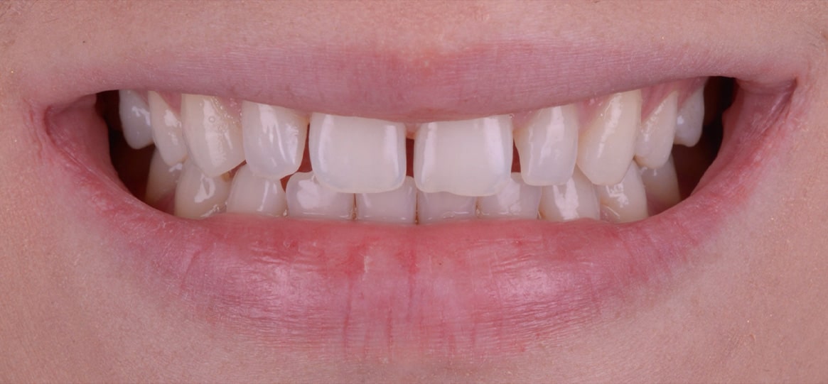 dana tratamente estetice cu fatete dentare clinica stomatologie timisoara clinica rugina (2)