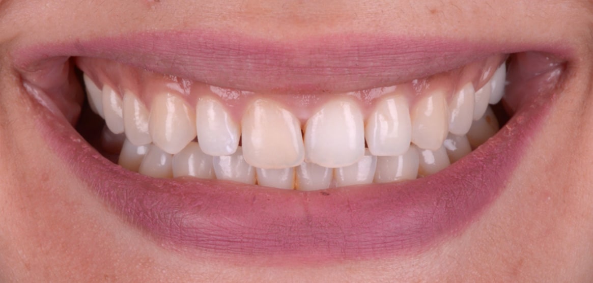 simona estetica dentara restaurari din compozit fatete dentare feldspatice