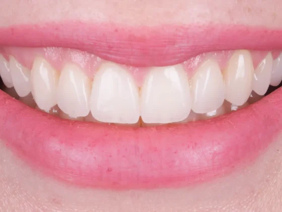 Fațete dentar act medical sau estetic clinica rugina
