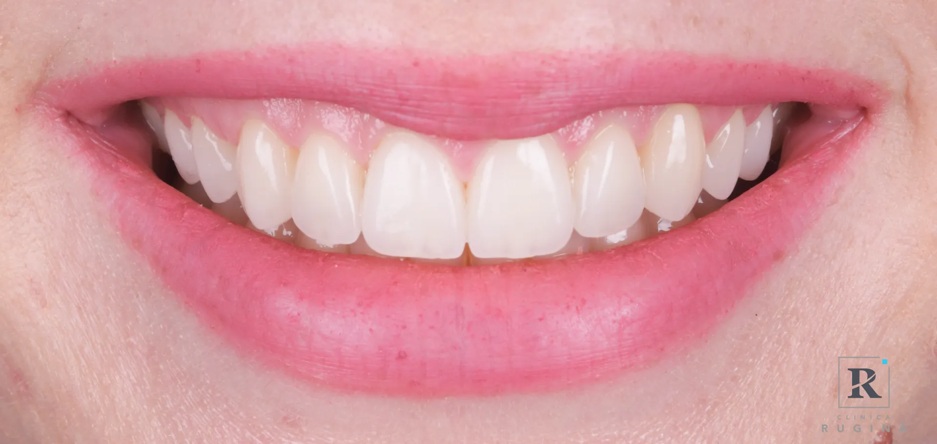 Fațete dentar act medical sau estetic clinica rugina